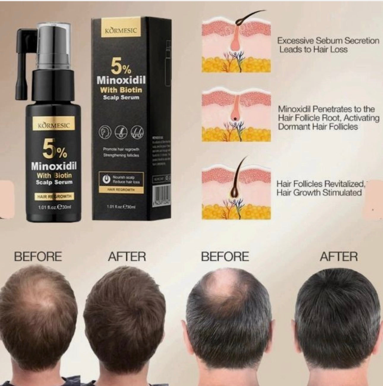 Kormesic 5% Minoxidil Biotin Scalp serum 30ml